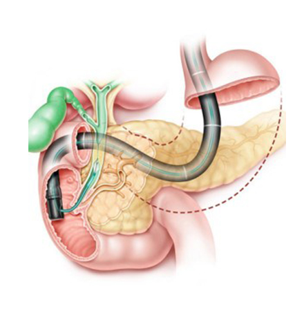 Colangiopancreatografia retrograda endoscópica (CPRE)