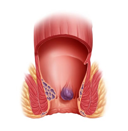 Termocoagulación de hemorroides