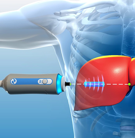 Fibroscan