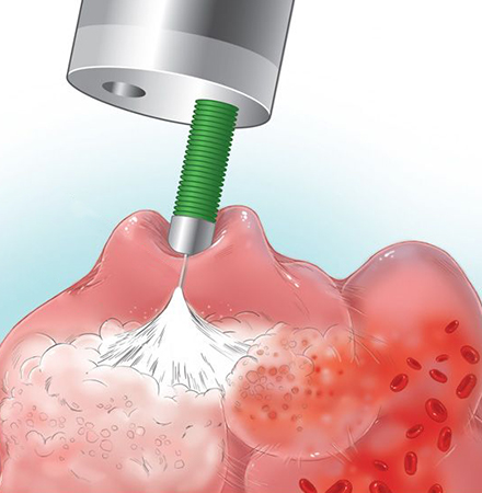 Inyectoterapia de várices gástricas